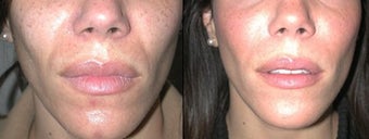  Juvederm to Laugh Lines