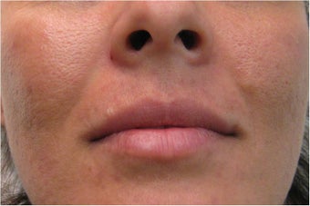 Juvederm for upper lip and nasolabial folds