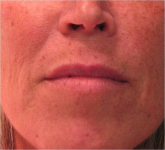 Juvederm to the upper lip