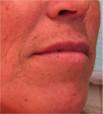 Juvederm to the upper lip