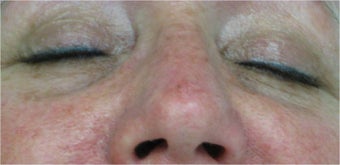Juvederm for lower eyelid hollows