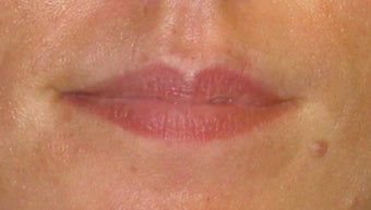 Juvederm Lip Augmentation
