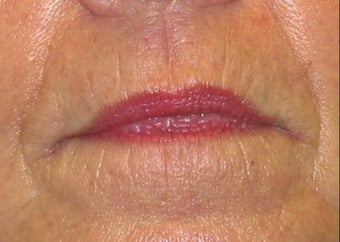 Juvederm effacement of perioral lines