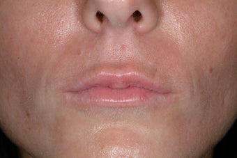 Juvederm Ultra