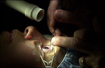Lasik surgery