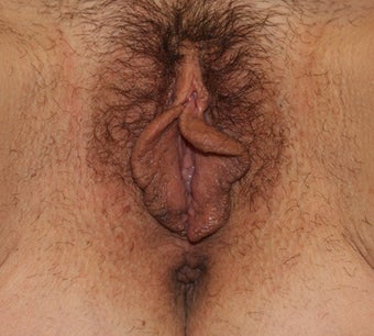 Vaginoplasty