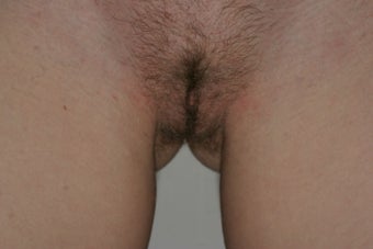 Labiaplasty
