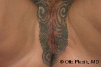 Labia Majora Augmentation with Lipoinjectio