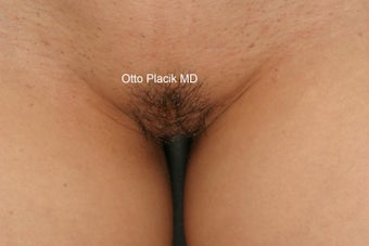 Labiaplasty