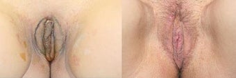 Labiaplasty before and after photos