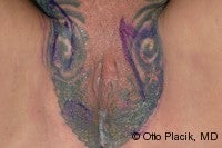 Labia Majora Augmentation with Lipoinjectio