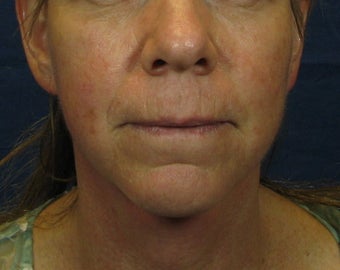 Laser Facelift