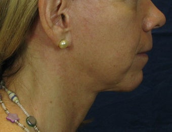 Laser Facelift