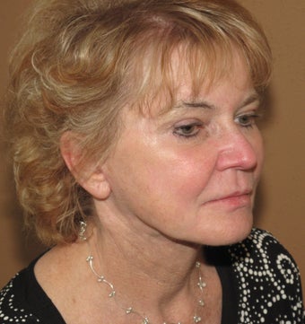 laser resurfacing