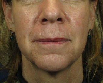 Laser Facelift