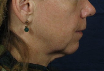 Laser Facelift