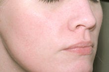 Laser Genesis for Overall Redness