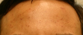 Cutera Laser Genesis