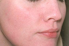 Laser Genesis for Overall Redness