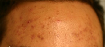 Cutera Laser Genesis