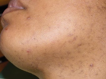 Laser hair removal in African-American