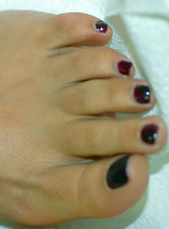Los Angeles Laser Hair Removal on the Feet
