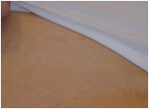 laser hair removal