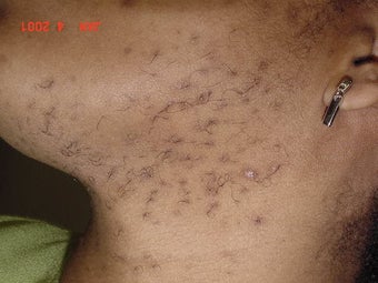 Laser hair removal in African-American