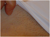 laser hair removal