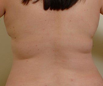 Laser assisted liposuction