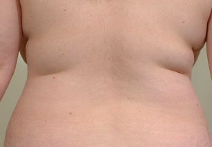 Laser assisted liposuction