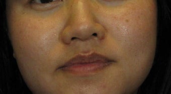 Laser Peels and More Perfect for Ethnic Skin Tones