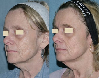 Fraxel repair with C02/Erbium lasers for upper lip wrinkles