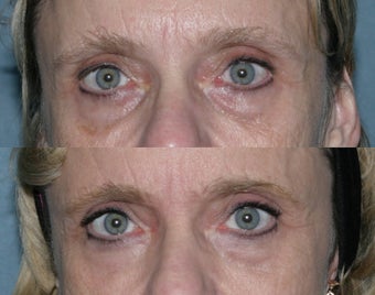 Fraxel repair with C02/Erbium lasers for upper lip wrinkles