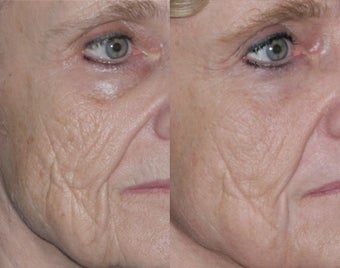 Fraxel repair with C02/Erbium lasers for Upper lip wrinkles