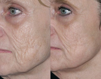 Fraxel repair with C02/Erbium lasers for upper lip wrinkles