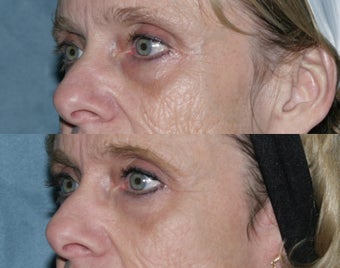 Fraxel repair with C02/Erbium lasers for upper lip wrinkles