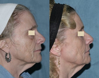 Fraxel repair with C02/Erbium lasers for upper lip wrinkles