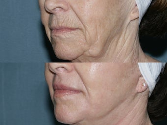 Face and neck Fraxel repair with C02/Erbium lasers for upper lip wrinkles