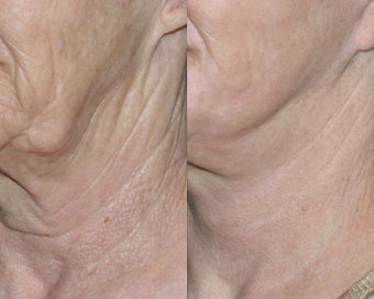 Fraxel repair for neck with C02/Erbium lasers