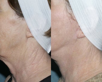 Fraxel repair for neck with laser peel treatment