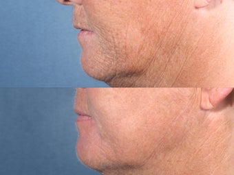 Laser Resurfacing
