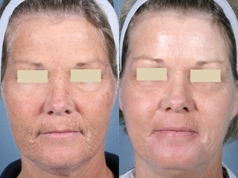 Laser Peel Treatments