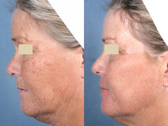 Laser Resurfacing