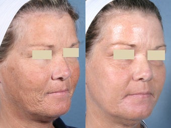 Laser Resurfacing