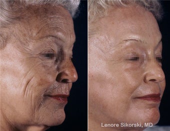 Full Face Erbium Laser