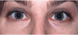 Laser Resurfacing with Erbium laser