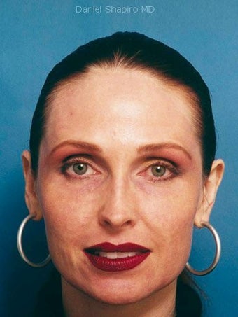 Full face erbium laser resurfacing