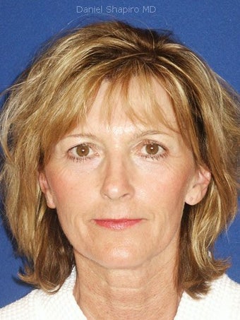 Full face erbium laser resurfacing