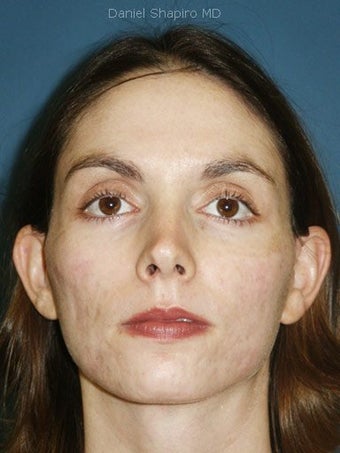 Full face erbium laser resurfacing